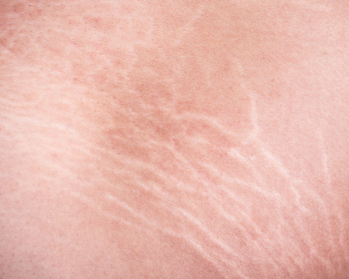 Stretch-marks.jpg