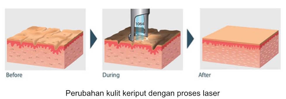 Perubahan-kulit-keriput-dengan-laser.jpg