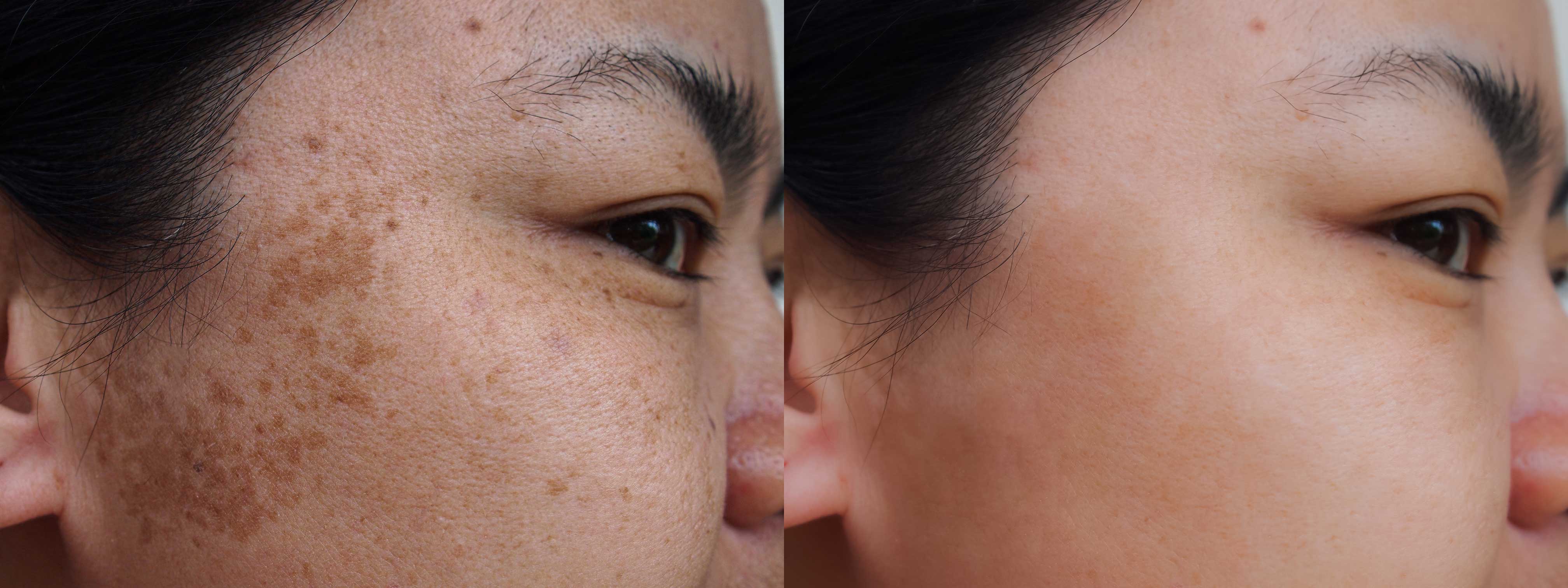 melasma-before-after-laser-pico