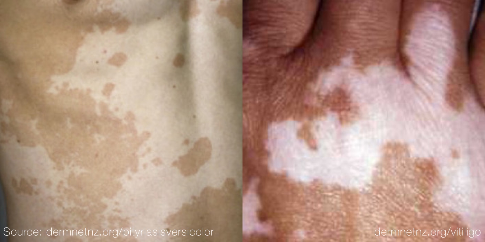 Panu-vs-vitiligo-gambar.jpg