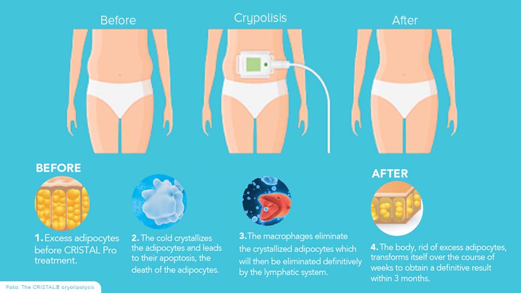 Prosedur Perawatan Cryolipolysis