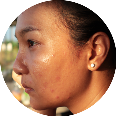 sunscreen-untuk-acne-prone-skin,jpg